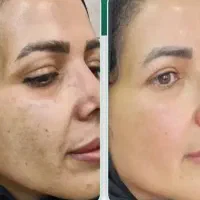 مزوتراپی موو پوست ضد لک  و منافذ،درمان واریس