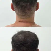 پرپشتی مو در سه جلسه با میکرواسکالپ