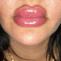 تزریق ژل و بوتاکس تخصصی