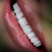 ایمپلنت کامپوزیت لمینت اقساط ویژه