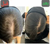 مراقبت ازمو