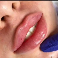 تزریق چربی صورت وبدن و تزریق فیلر