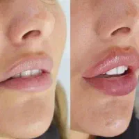 تزریق ژل و بوتاکس