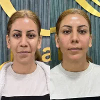 کلینیک زیبایی الارا انجام خدمات ژل و بوتاکس
