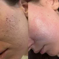 فیشال تخصصی با دستگاه های تخصصی