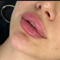 خدمات فیلر زیبایی