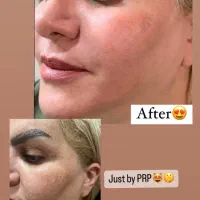 پی آر پی صورت‌ مو با کیت ویژه،،پلاسما ژل،خالبرداری