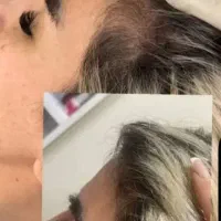 تزریق مزوژل پی ارپی برای رشد مجددموهاو جوانسازصورت