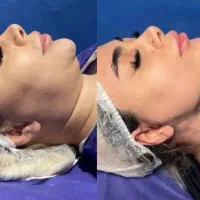 رکورد دار ساکشن غبغب و‌سوپرکانتورینگ‌