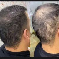 از جمع کچلا دربیا