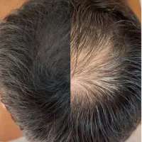 تکمیل کاشت مو با میکرو اسکالپ