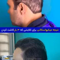 میکرواسکالپ/ میکرو اسکالپ / مکمل و جایگزین کاشت مو