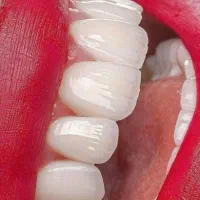 تخفیف ویژه کامپوزیت دندان .ایمپلنت دندانپزشکی. عصب