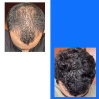 با کم پشتی خداحافظی کن