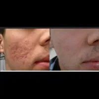 مرکز تخصصی لیزر co2فرکشنال