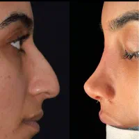 ۱۲ میلیون تخفیف جراحی بینی فقط تا ۲۰ دی