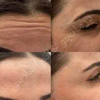 کرم بیو ممتیک
