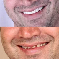 لمینت متحرک دندان