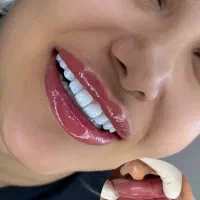 کامپوزیت،روکش،لمینت