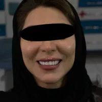 کامپوزیت زیبایی کامپوزیت دندان باضمانت کتبی ۵ ساله