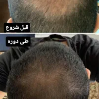 مشاوره ریزش مو و رشد مجدد ( موی سر و ریش و سبیل )