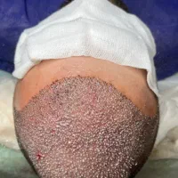 کاشت مو به جدید ترین روش‌ ۱۳میلیون