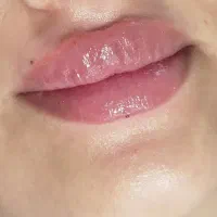ژل و بوتاکس