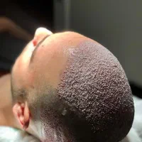 جشنواره تابستانه کاشت موی سر