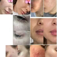 ژل بوتاکس فیلر. مزونیدلینگ. مزوتراپی. تخفیف ویژه