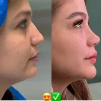 جشنواره عمل  بینی لیزری در  تهران و شیراز