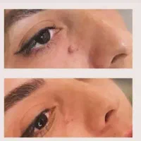 برداشت خال لک و زگیل لیفت ابرو و مژه