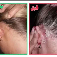 درمان قطعی پسوریازیس