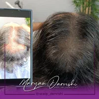 میکرواسکالپ سر ،اسکالپ سر ، پرپشتی مو در مطب پزشک