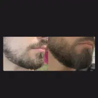 تراکم بالا یا ریش