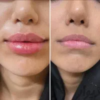 لیزر موهای زائد ۲۰۲۶ ، بوتاکس،فیلر توسط پزشک