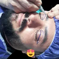 بلفاروپلاستی/جراحی پلک/بلفارو/مدل گربه/بوکال فت