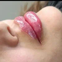 تزریق ژل و بوتاکس تخفیف ویژه ب مدت یک هفته