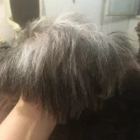پروتز مو نانو با چسب و