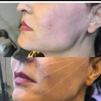 تزریق ژل و بوتاکس ونخ لیفت در منزل