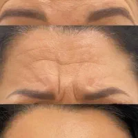 آموزش ژل و بوتاکس