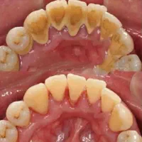دندان پزشکی تخفیف ویژه جرمگیری