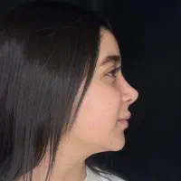 عمل جراحی بینی متخصص گوش حلق وبینی /باهزینه پارسال