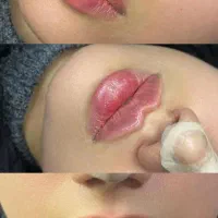ژل و بوتاکس تخفیف ویژه و مزو