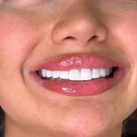 دندانپزشکی،کامپوزیت، لمینیت