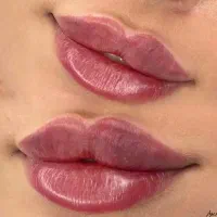 جشنواره تخفیف تزریق ژل لب بوتاکس چشم گربه ای شقیقه