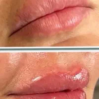 تزریق بوتاکس فیلر لب، گونه چانه پی آر پی توسط پزشک