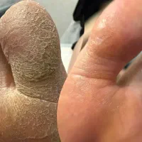 مژه کوتاهی کراتین اصلاح شمع رنگلایت