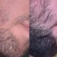 رویش ریش با تحول چهره