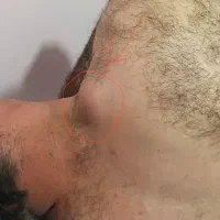 جراحی غده چربی (لیپوم)،و کیست مویی با ۳۰ درصدتخفیف