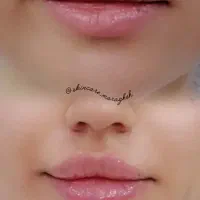 لیزر موهای زائد و جوانسازی،مراغه